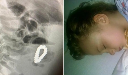 4 Jähriger verschluckt 18 teiliges Magnetarmband